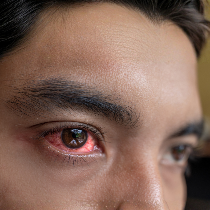 Laser Eye Surgery Calgary